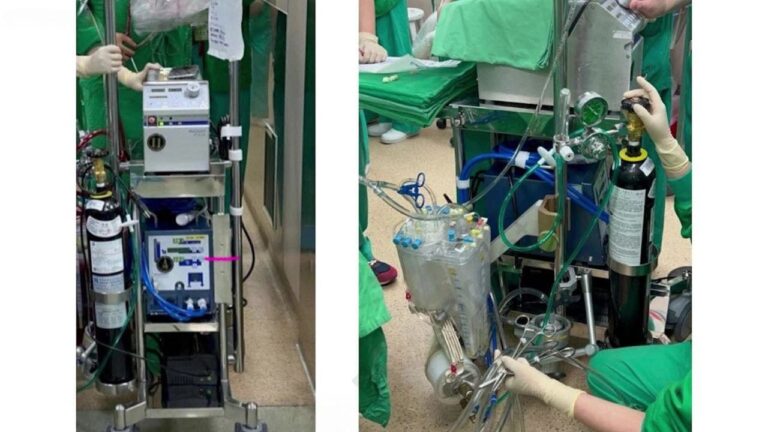 1 worlds first beating heart transplant that never stops